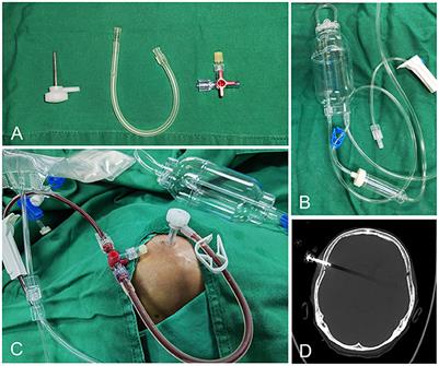 Subdural evacuating port system with subdural thrombolysis for the treatment of chronic subdural hematoma in patients older than 80 years